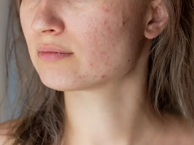 คลินิกรักษาสิว ที่ไหนดี - 4