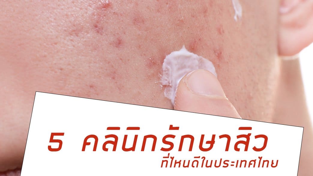 คลินิกรักษาสิว ที่ไหนดี